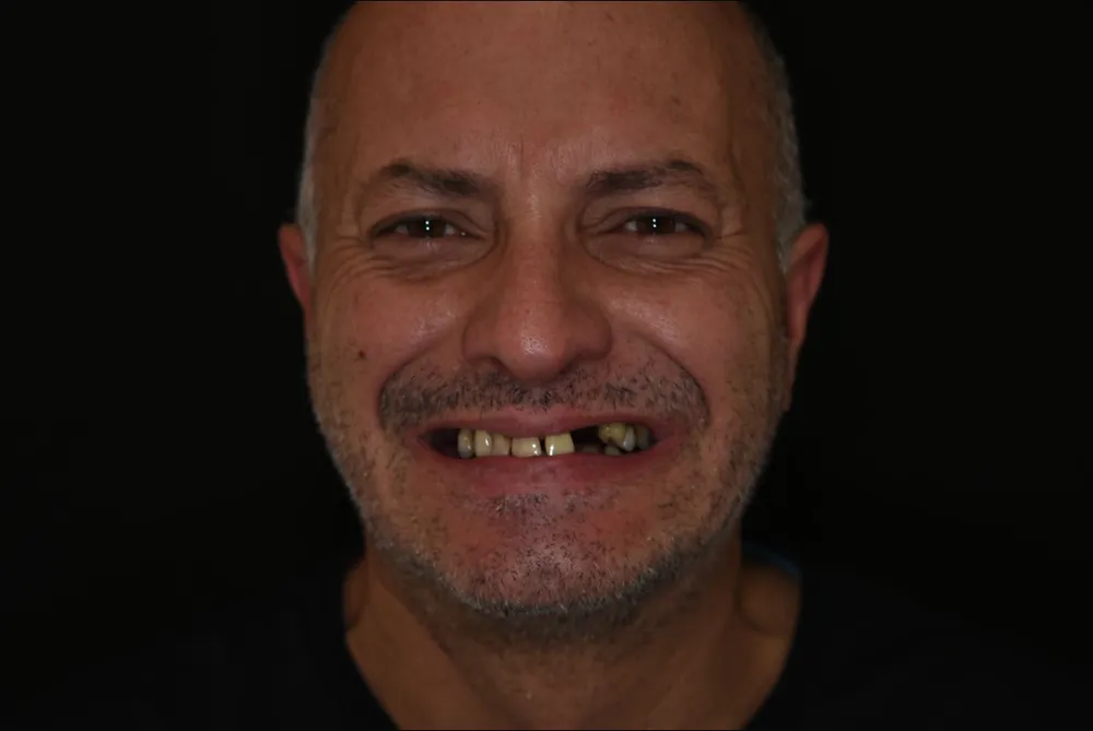 Paciente antes do tratamento, com dentes faltando