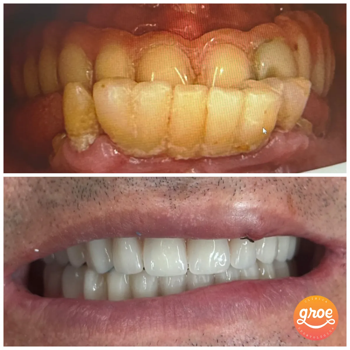 Antes e depois de reabilitação com implantes