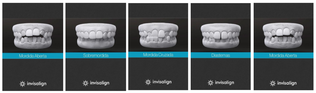 Iinvisalign width=