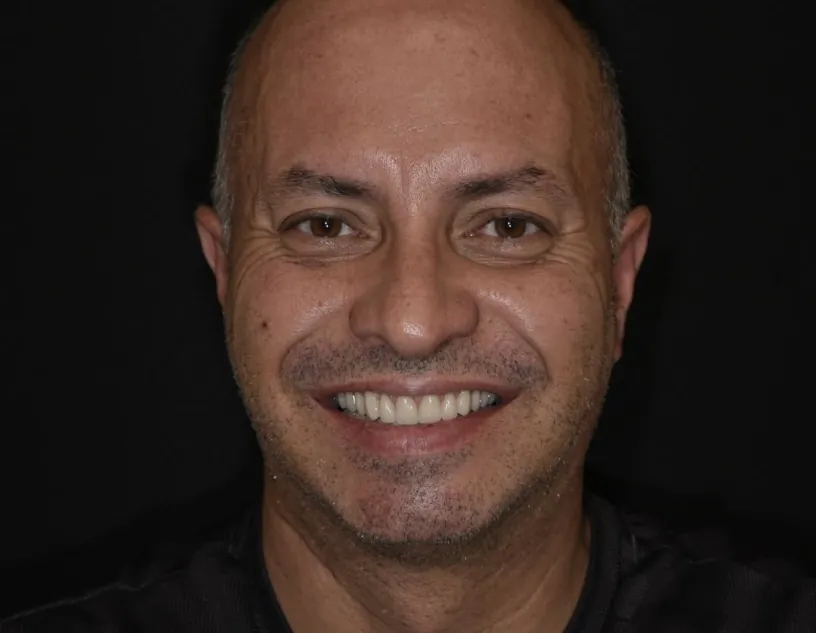 Paciente sorrindo após reabilitação com implantes