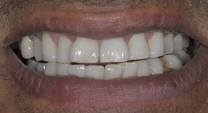 Sorriso reabilitado com implantes, caso 2
