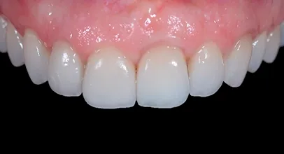 Sorriso reabilitado com implantes, caso 3