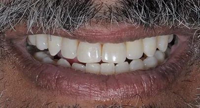 Sorriso reabilitado com implantes, caso 6