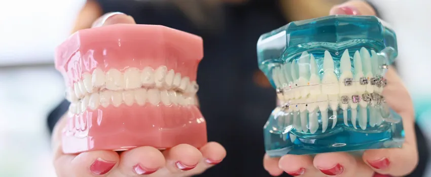 Modelos de arcada dentária e alinhadores